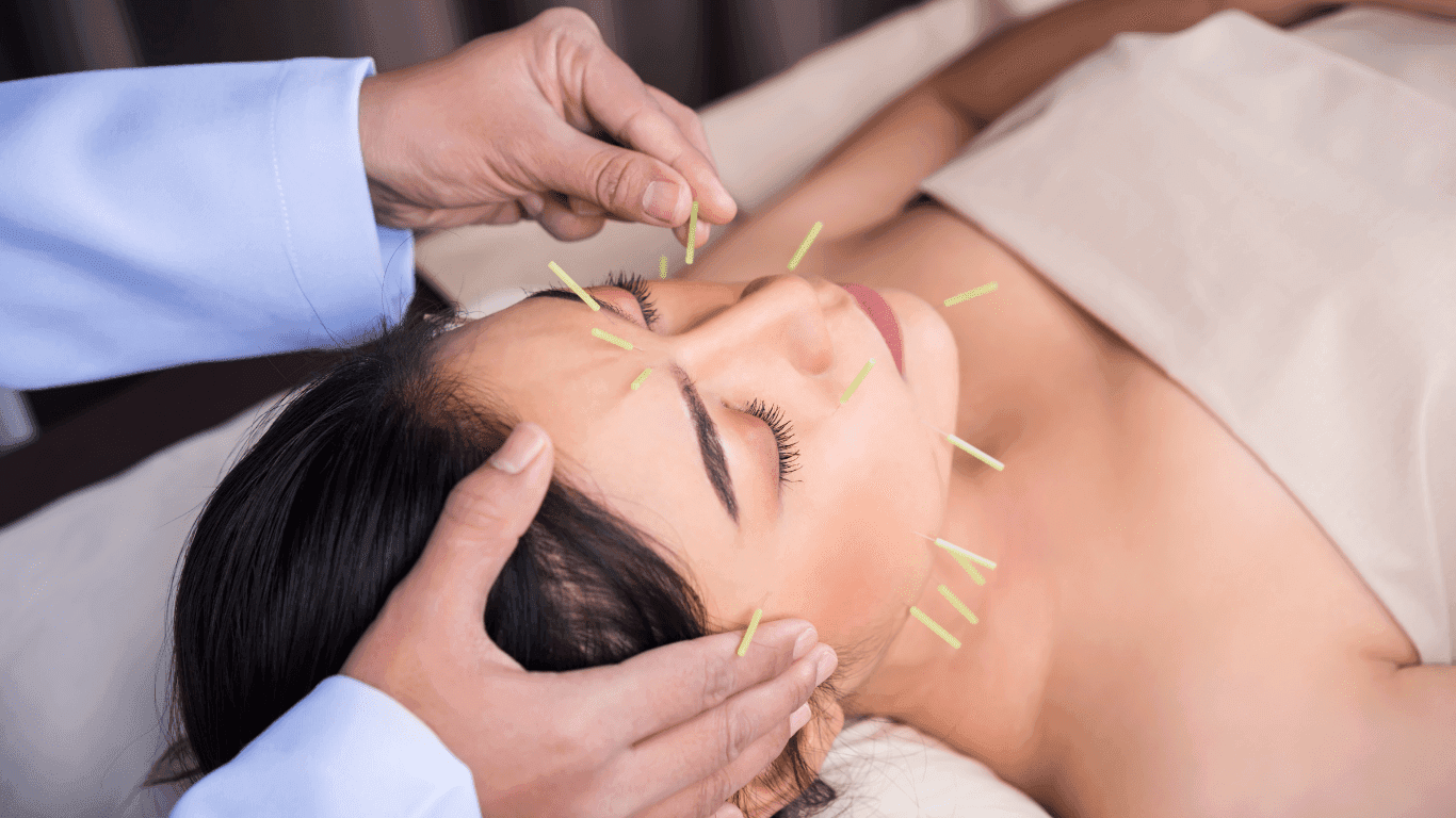 美容鍼とは