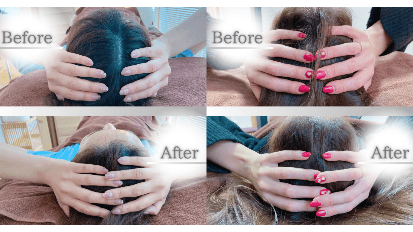 美容鍼のビフォーアフター